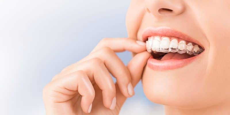 Questions and Answers About Braces